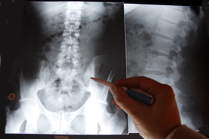 Hip Fractures Connected to Lack of Vitamin K.